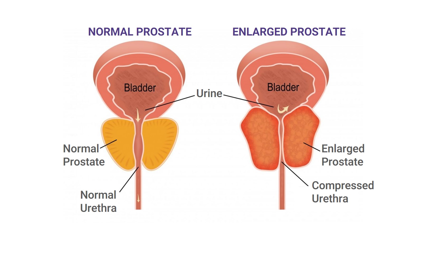 Benign Prostatic Hyperplasia (BPH) Treatment in Ahmedabad - Dr. Sharad ...