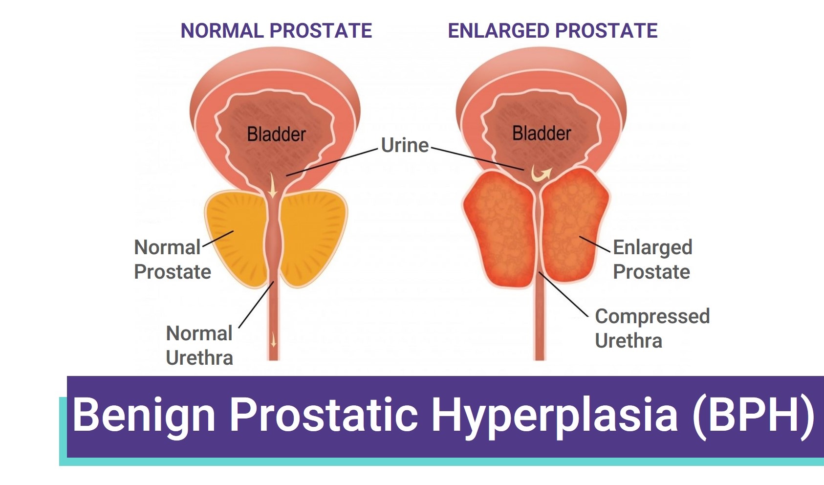 Benign Prostatic Hyperplasia Bph Treatment In Ahmedabad Dr Sharad Dodiya 8315